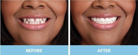 snap-on-smile4.jpg